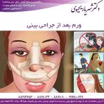 ورم بعد از جراحی بینی