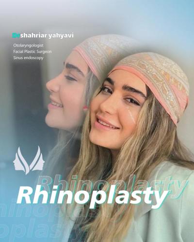 Rhinoplasty : before and after, results