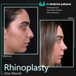 Thin skin nose rhinoplasty