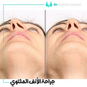 جراحة الأنف الملتوي في ايران