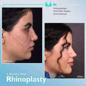 بهترین جراح بینی تهران - دکتر یحیوی