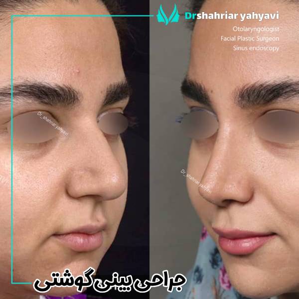 جراحی بینی گوشتی در تهران - دکتر شهریار یحیوی
