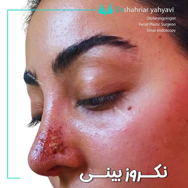 نکروز بینی + دکتر شهریار یحیوی