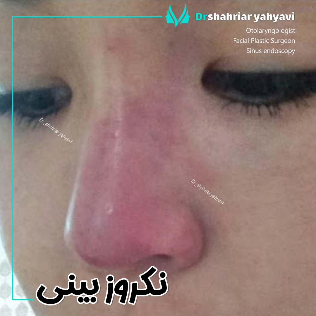 نکروز بینی - دکتر شهریار یحیوی
