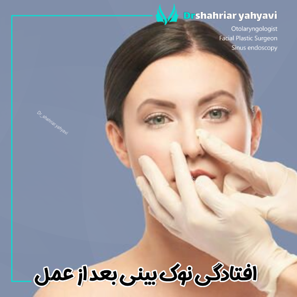 افتادگی نوک بینی بعد از عمل - دکتر شهریار یحیوی
