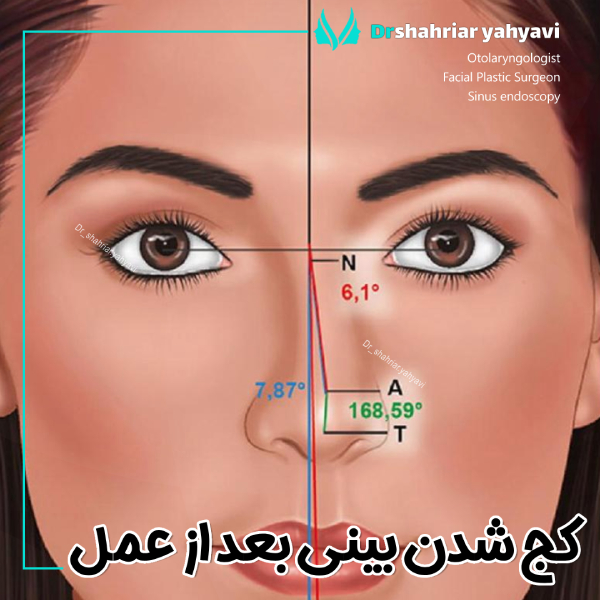 کج شدن بینی بعد از عمل با دکتر شهریار یحیوی