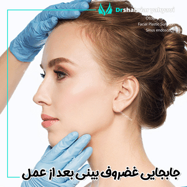 جابجایی غضروف بینی بعد از عمل + دکتر شهریار یحیوی