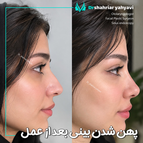پهن شدن بینی بعد از عمل + دکتر شهریار یحیوی