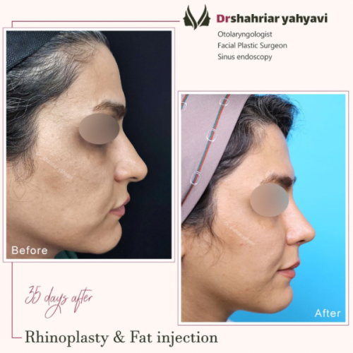 جراحی-بینی-867
