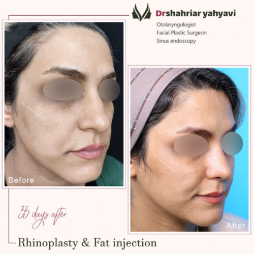 جراحی-بینی-868