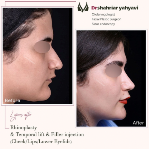 جراحی-بینی-869
