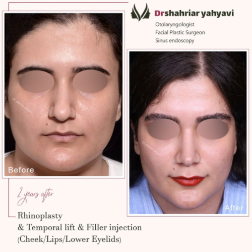 جراحی-بینی-870