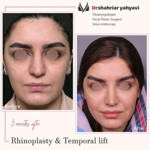 جراحی-بینی-871