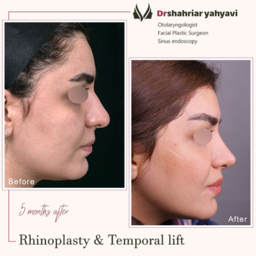 جراحی-بینی-872