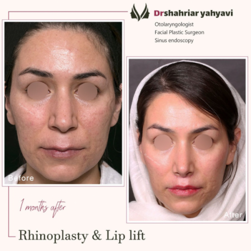 جراحی-بینی-873