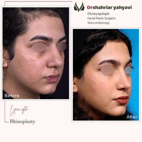 جراحی-بینی-878