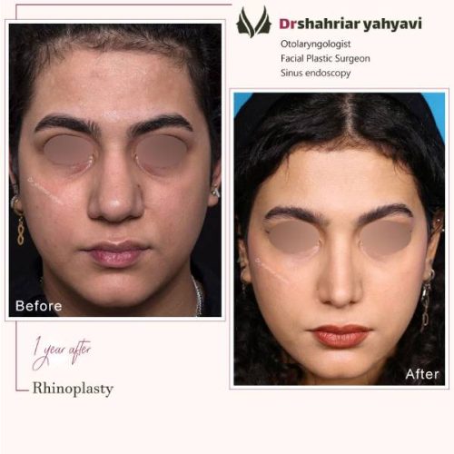 جراحی-بینی-879