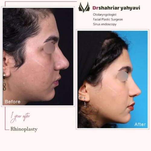 جراحی-بینی-880