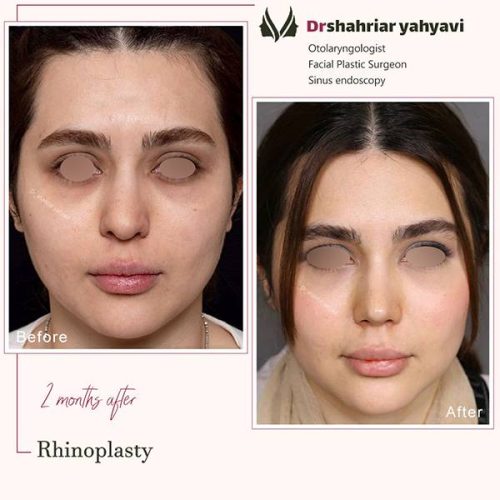 جراحی-بینی-882