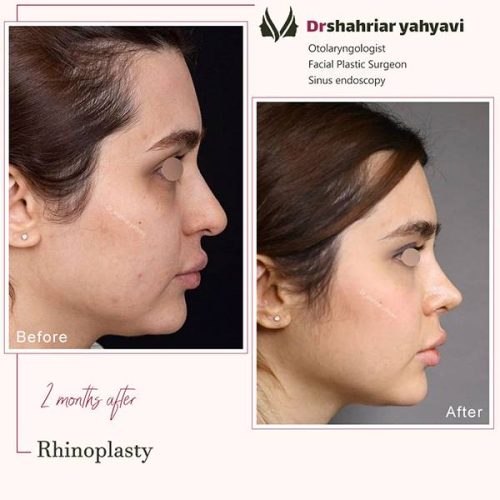 جراحی-بینی-883