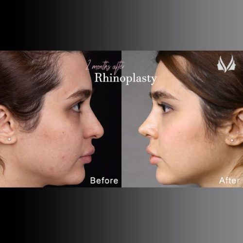 جراحی-بینی-884