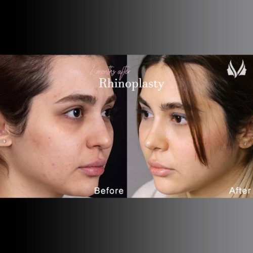 جراحی-بینی-885