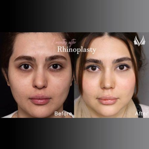 جراحی-بینی-886