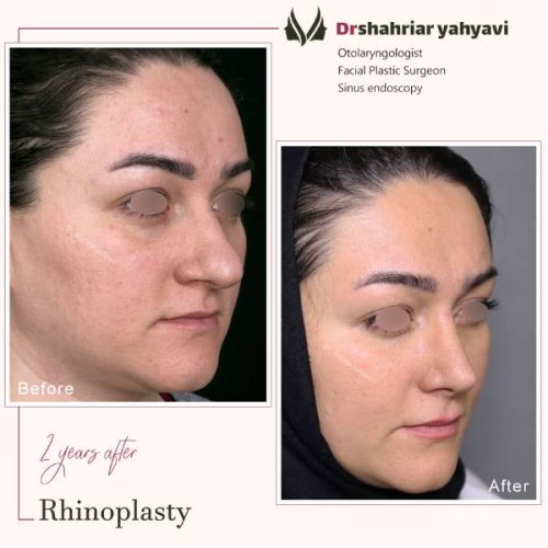 جراحی-بینی-889