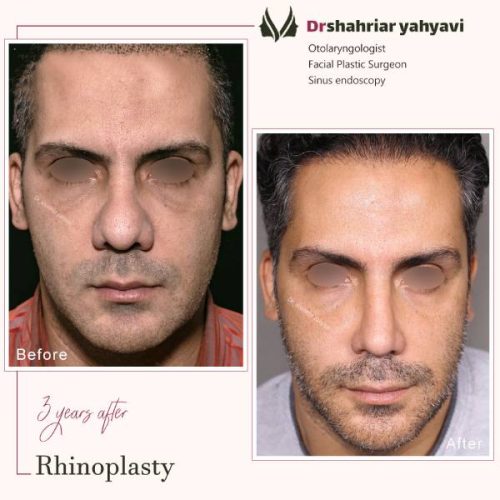 جراحی-بینی-890