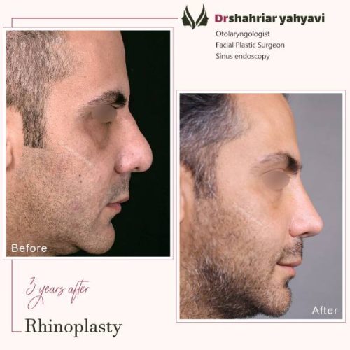 جراحی-بینی-891