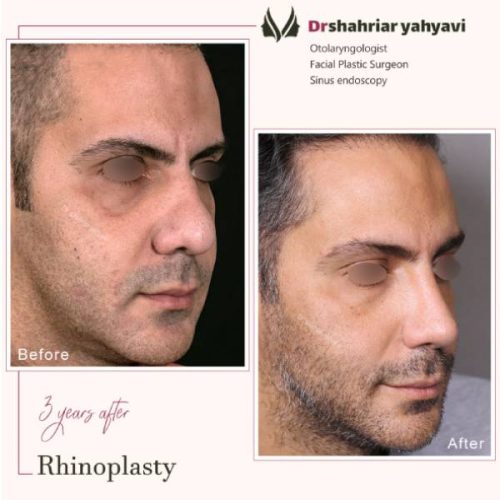 جراحی-بینی-892