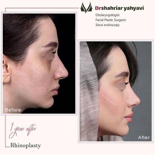 جراحی-بینی-894