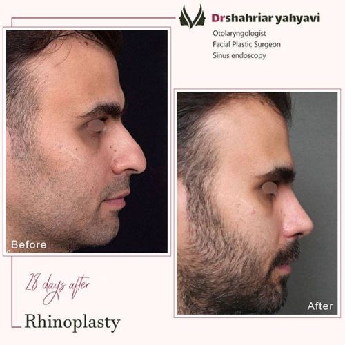 جراحی-بینی-896