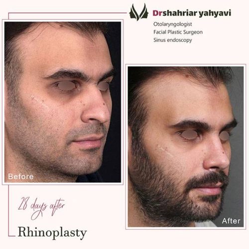 جراحی-بینی-897