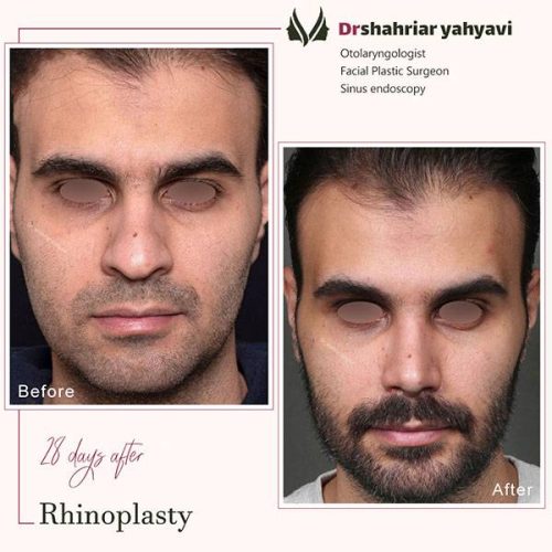 جراحی-بینی-898