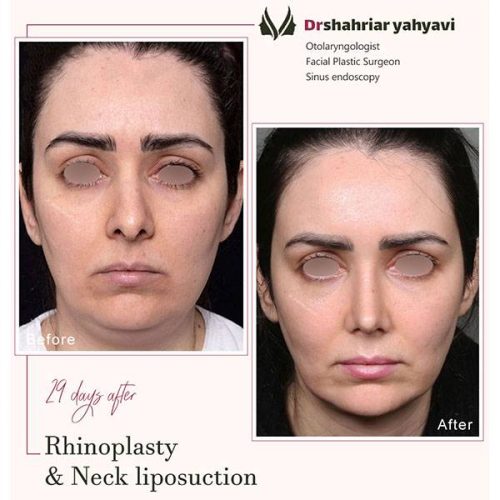 جراحی-بینی-899