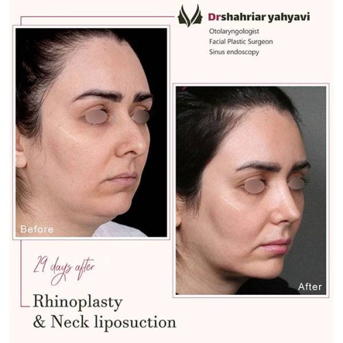 جراحی-بینی-900