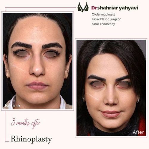 جراحی-بینی-902