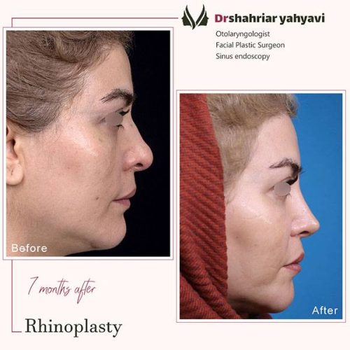 جراحی-بینی-905