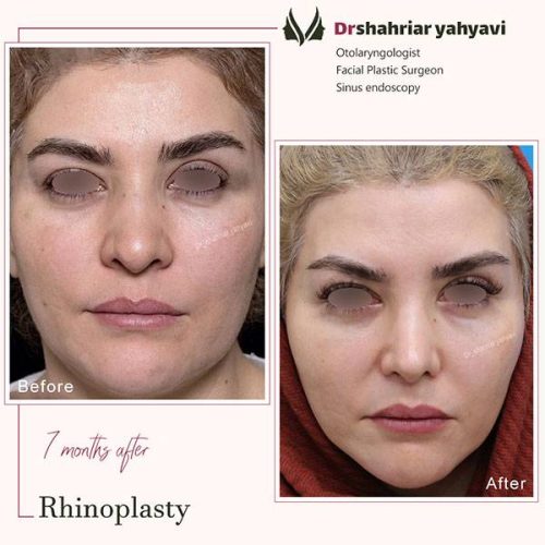 جراحی-بینی-907