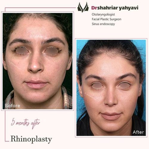 جراحی-بینی-908