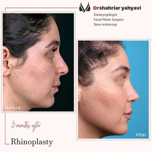 جراحی-بینی-909