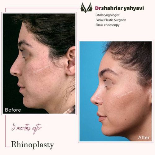 جراحی-بینی-910