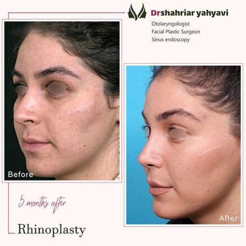 جراحی-بینی-911