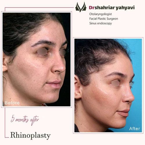 جراحی-بینی-912
