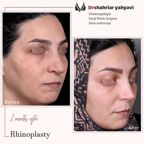 جراحی-بینی-913