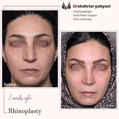 جراحی-بینی-914