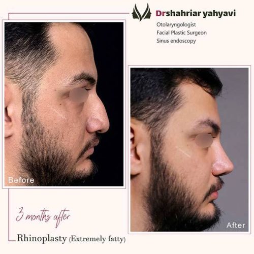 جراحی-بینی-915