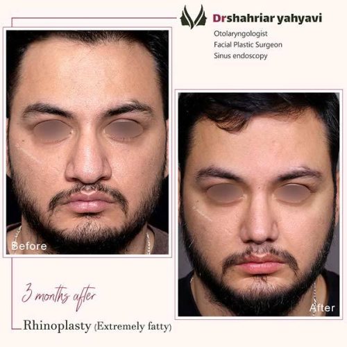 جراحی-بینی-916