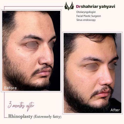 جراحی-بینی-917